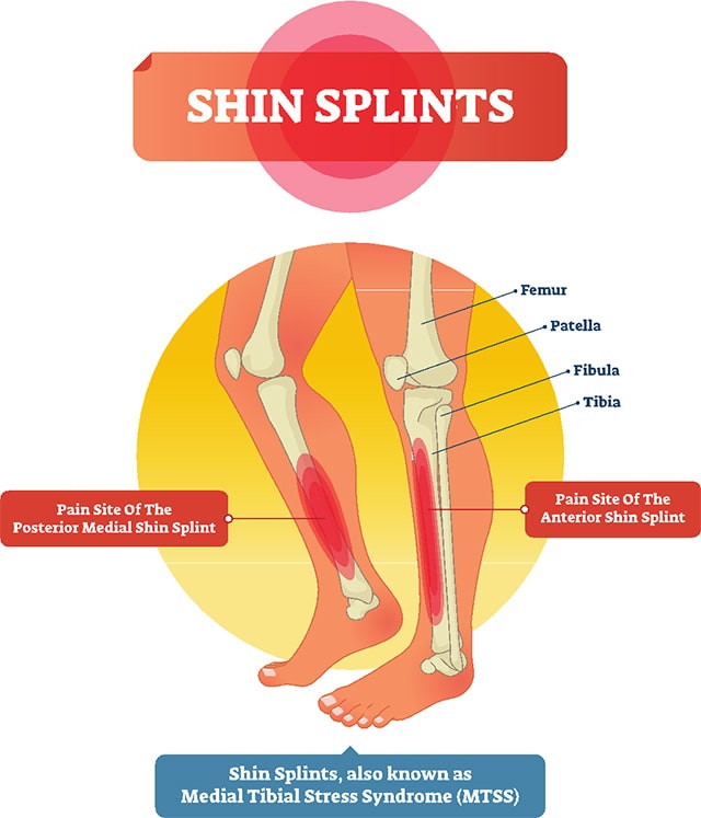 The 5 Most Common Netball Injuries and How to Prevent Them