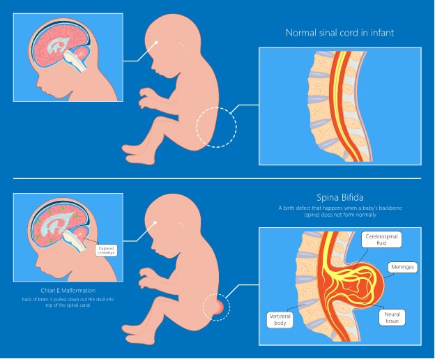 Spina Bifida Physiotherapy Management